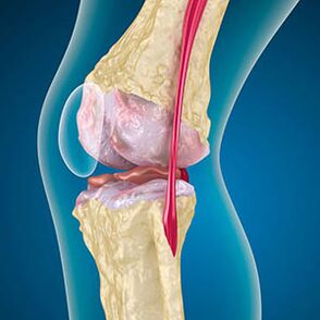 La tension excessive du muscle de la cuisse provoque une douleur au genou