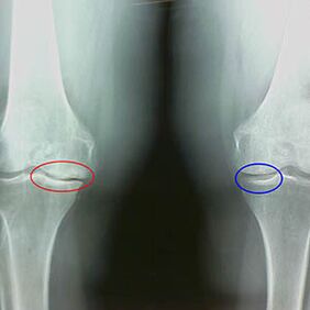 Ostéoarthrose articulaire du genou sur la radiographie