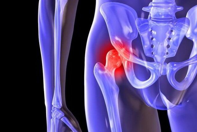 Processus pathologique dans l'articulation de la hanche avec coxarthrose.
